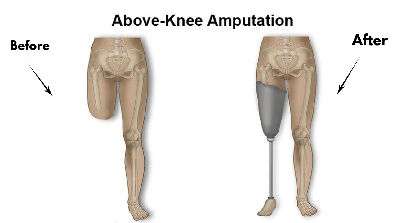 Above Knee Amputation: Surgery, Recovery & Prosthesis