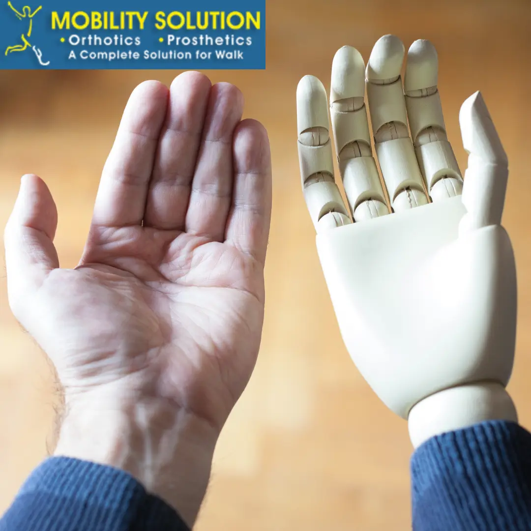 Prosthetic Hands: Cost in India, Types, and How They Work