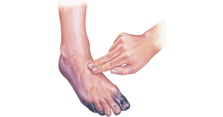 Gangrene treatment without surgery