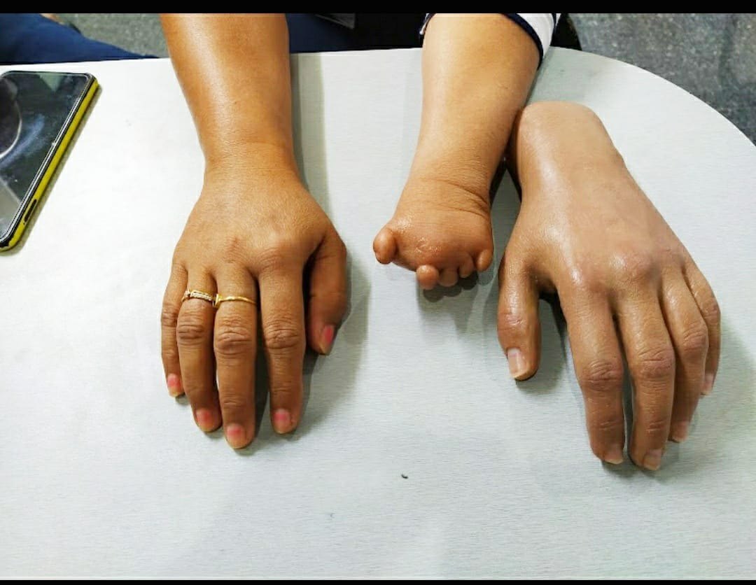 Partial Hand Prosthesis